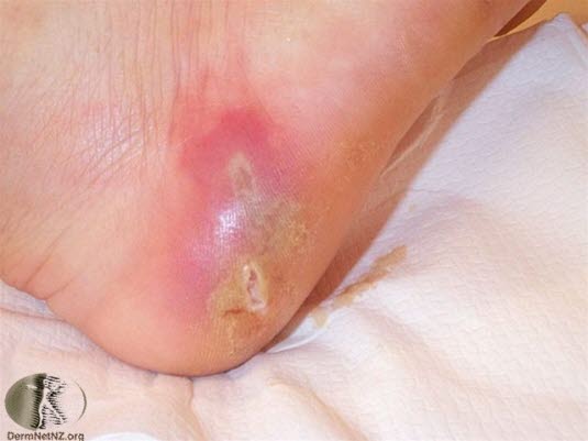 Abscesser i huden Abscesser i huden