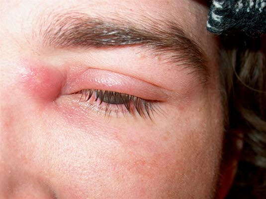 Hudabscess och cellulit Hudabscess och cellulit
