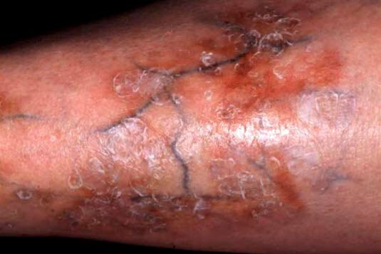 Necrobiosis lipoidica Necrobiosis lipoidica