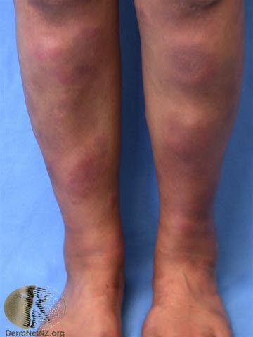 Erythema nodosum Erythema nodosum