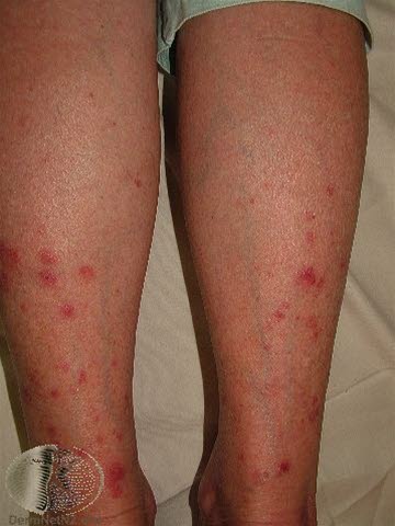 Soleksem (polymorf ljusdermatos) Soleksem (polymorf ljusdermatos)