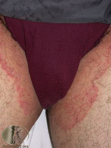 Tinea cruris Tinea cruris
