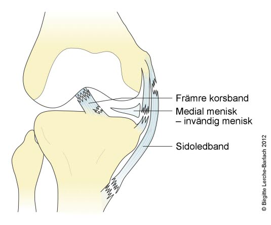 Knä, lesion av ledband, korsband och menisk