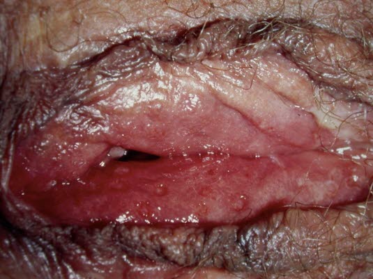 Herpes genitalis Herpes genitalis