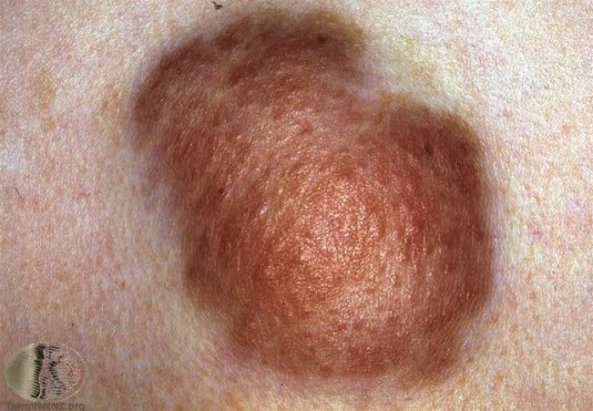 Plexiformt neurofibrom Plexiformt neurofibrom