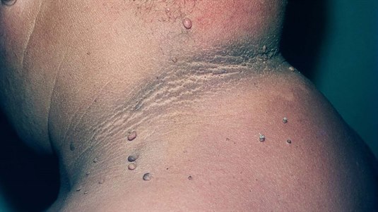 Acanthosis nigricans Acanthosis nigricans