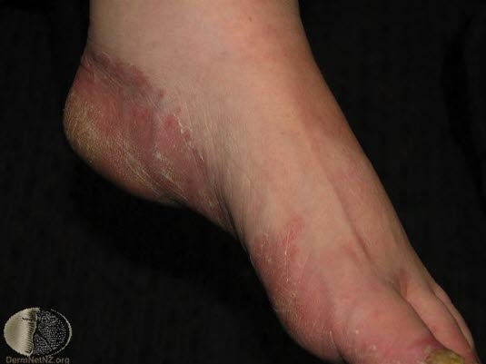 Tinea pedis, fotsvamp Tinea pedis, fotsvamp