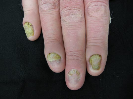 Yellow nail syndrome Yellow nail syndrome