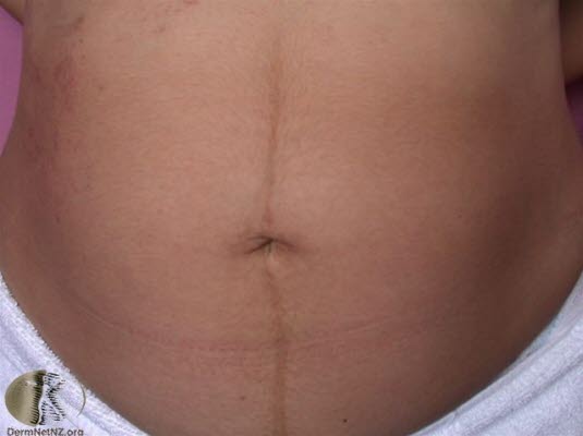 Linea nigra, graviditet Linea nigra, graviditet
