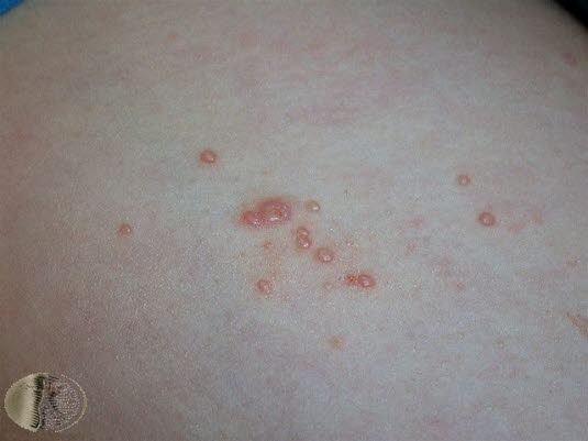 Mollusker (Molluscum contagiosum) Mollusker (Molluscum contagiosum)