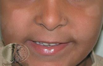 Pityriasis alba Pityriasis alba